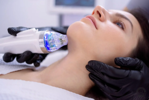 Rf Microneedling Hals 2 1