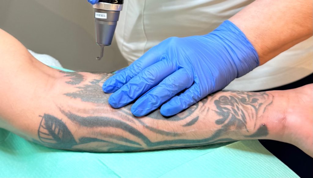 Nærbilde av laserbehandling for tatoveringsfjerning på arm - Korpeveien Legeklinikk Drammen