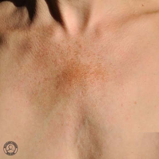 Pigmentflekker og solskader på hud